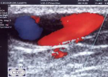 Eco doppler arterial venoso